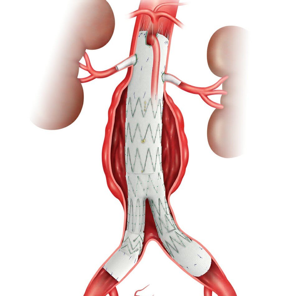 Defusing the Hidden Threat: Advanced Aneurysm Surgery in Mohali