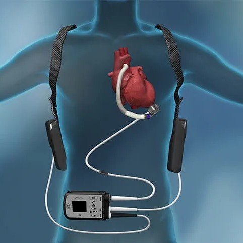 Lifesaving Innovation: Advanced LVAD Surgery in Mohali