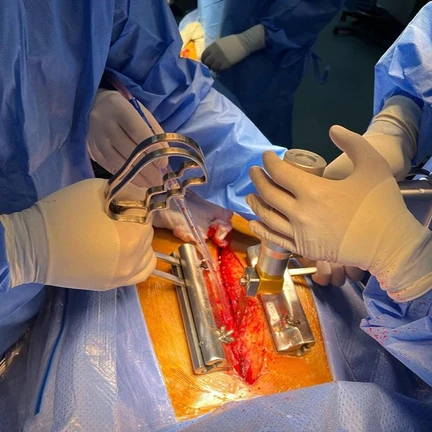 Redo Cardiac Surgery